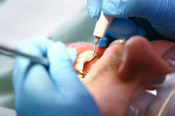 Best Emergency Dentist for Lost Fillings or Crowns in Edisto, SC